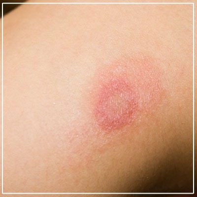 Fungal infection treatment in Colaba