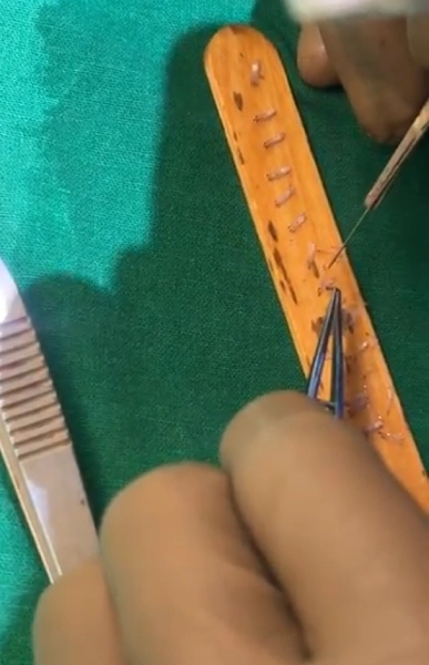 No of grafts 2000–2500