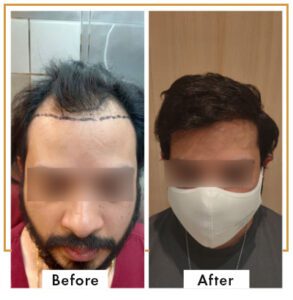 Before & After - Viva Aesthetic Clinic