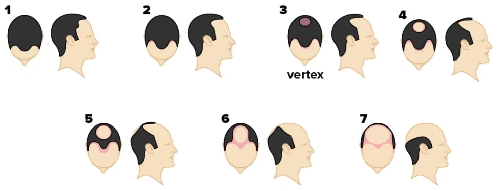 Stages of Baldness