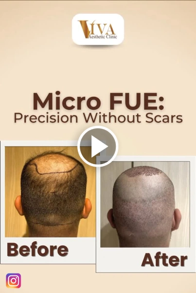 Micro FUE
