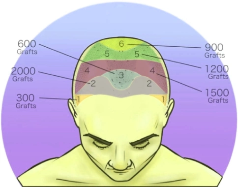 Hair transplant in Mumbai