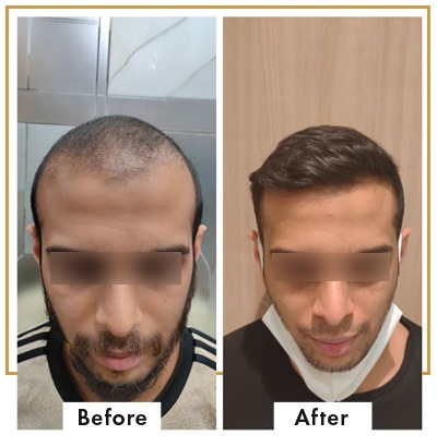 Hair transplant in Mumbai