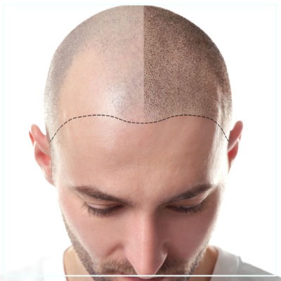 Hair transplant in Mumbai