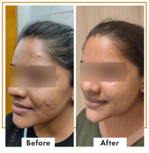 acne-therapy-treatment-results