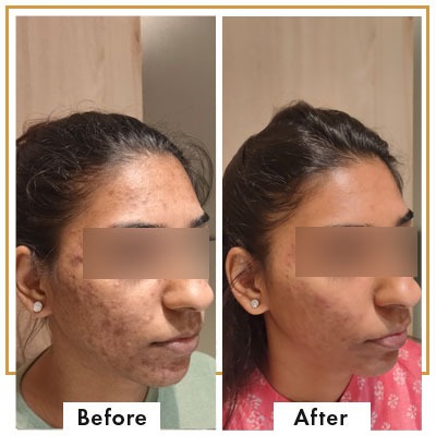 Before & After - Viva Aesthetic Clinic