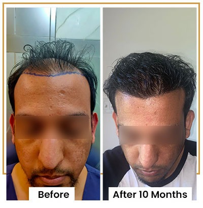 advantages of hair transplant