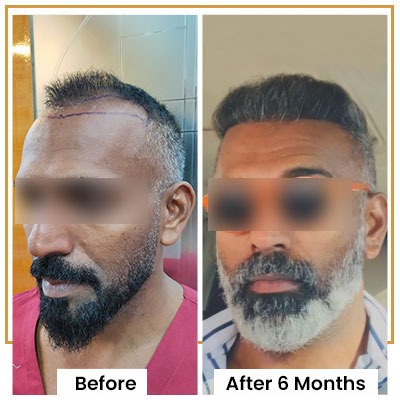 Hair Transplant