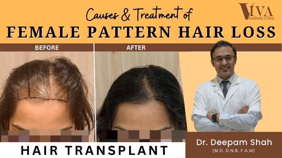 Causes and treatment female pattern hair loss