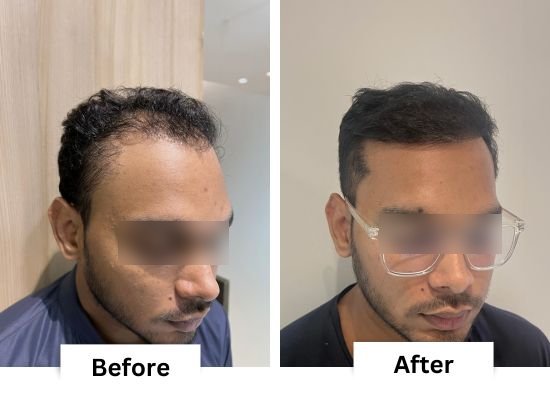 Hair transplant before and after 3