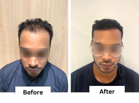 Hair transplant before and after result 2