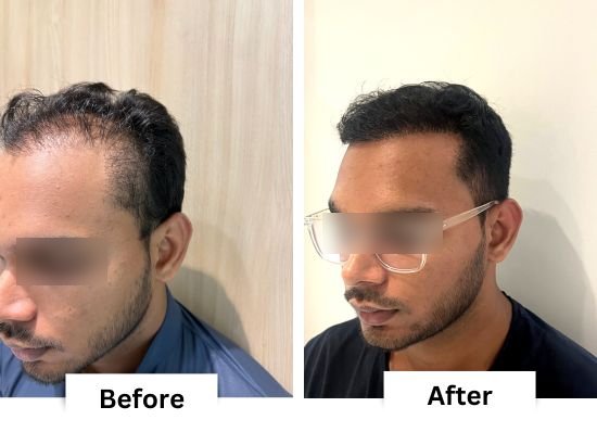 Hair transplant before and after result