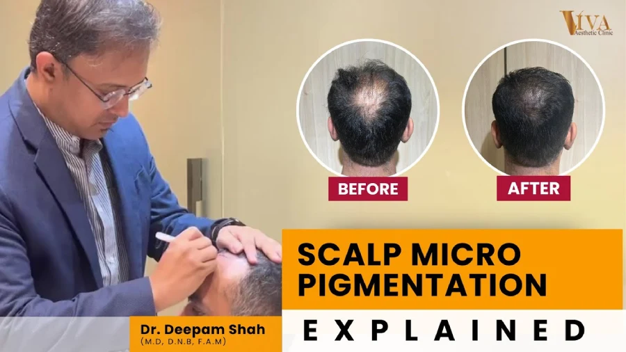 Scalp micro pigmentation explained
