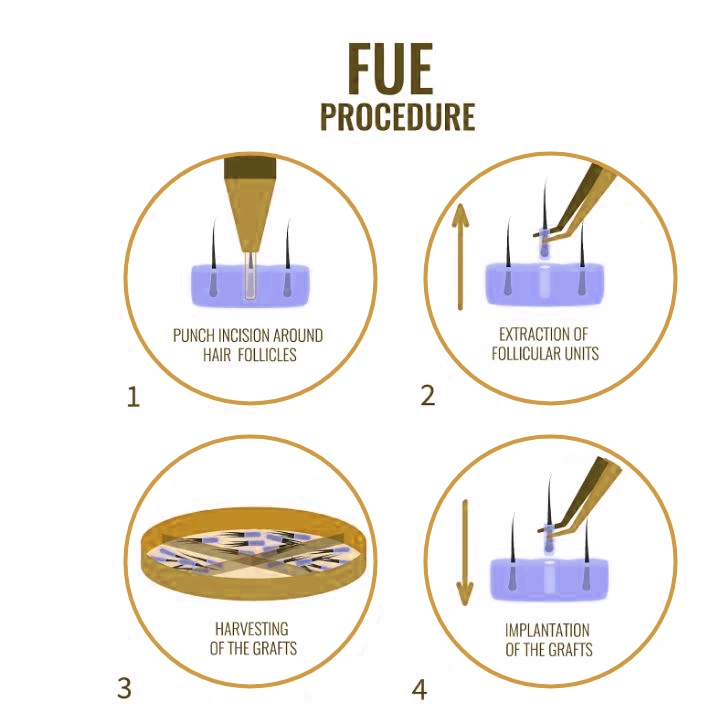 fue procedure