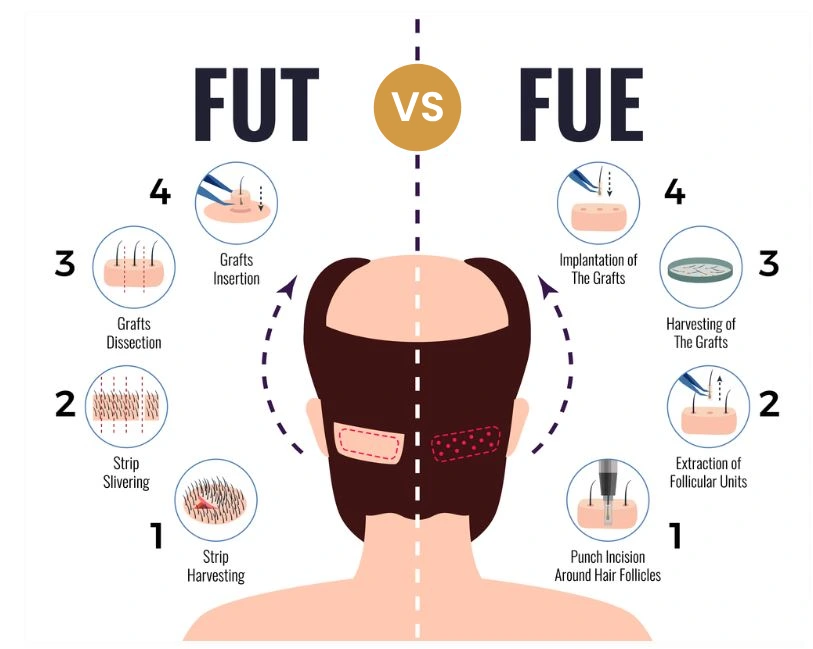 FUE hair transplant Mumbai 