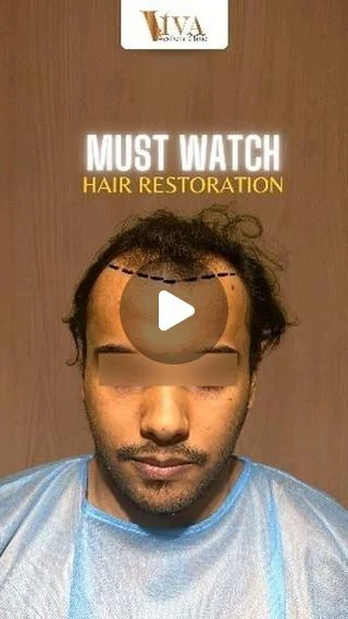 Must watch hair restoration