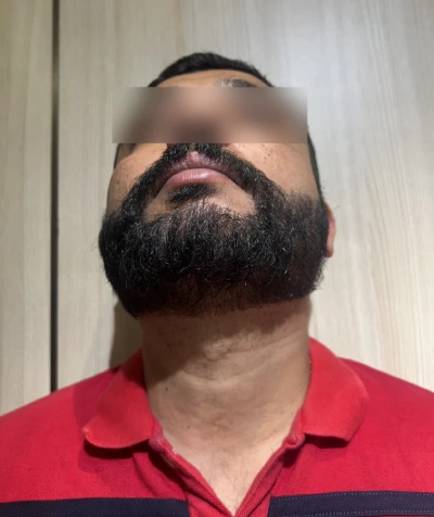 Beard Transplant in India