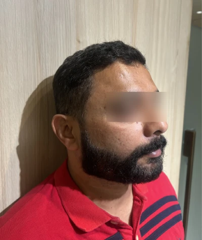 Beard Transplant in Mumbai