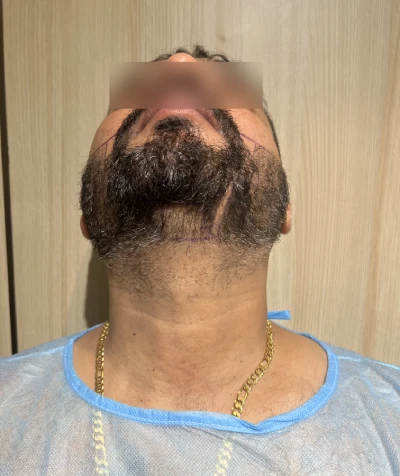 Beard Transplant Surgery in Mumbai