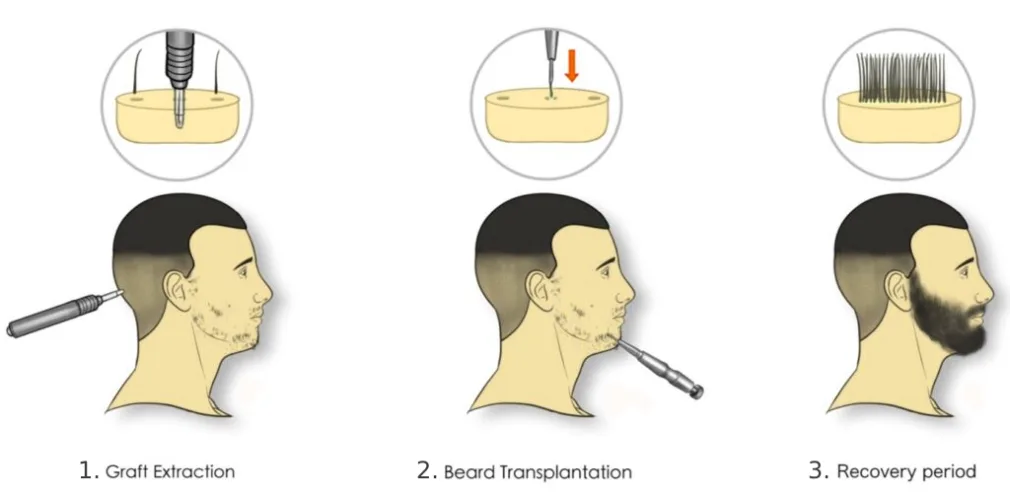 beard transplant procedure in mumbai