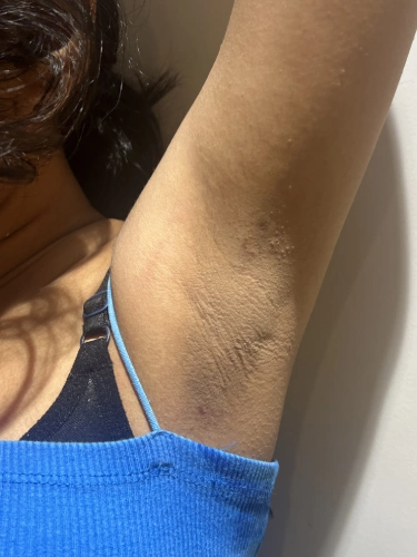 after Underarm Skin Lightening treatment in Mumbai