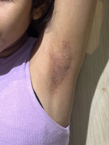 Before Underarm Skin Lightening treatment in Mumbai