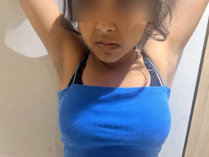best underarm skin lightening treatment