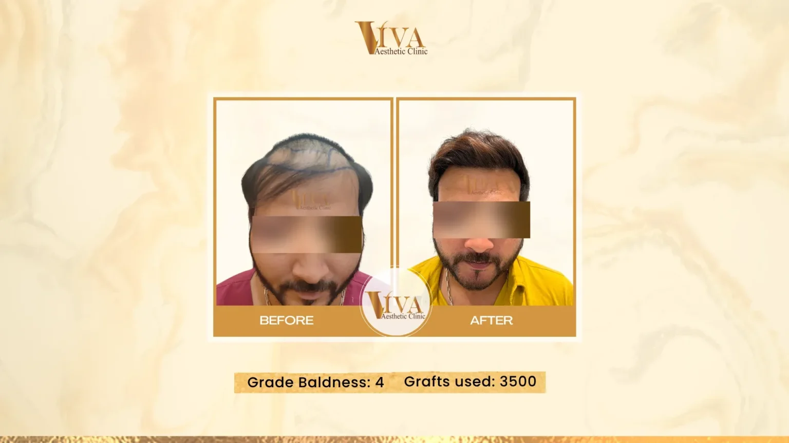 Hair Transplant Result