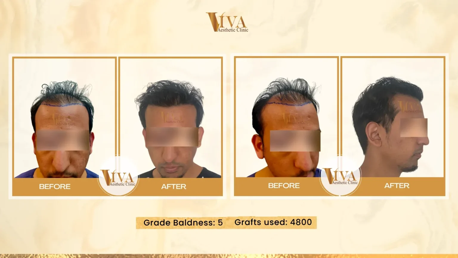 Hair Transplant Result