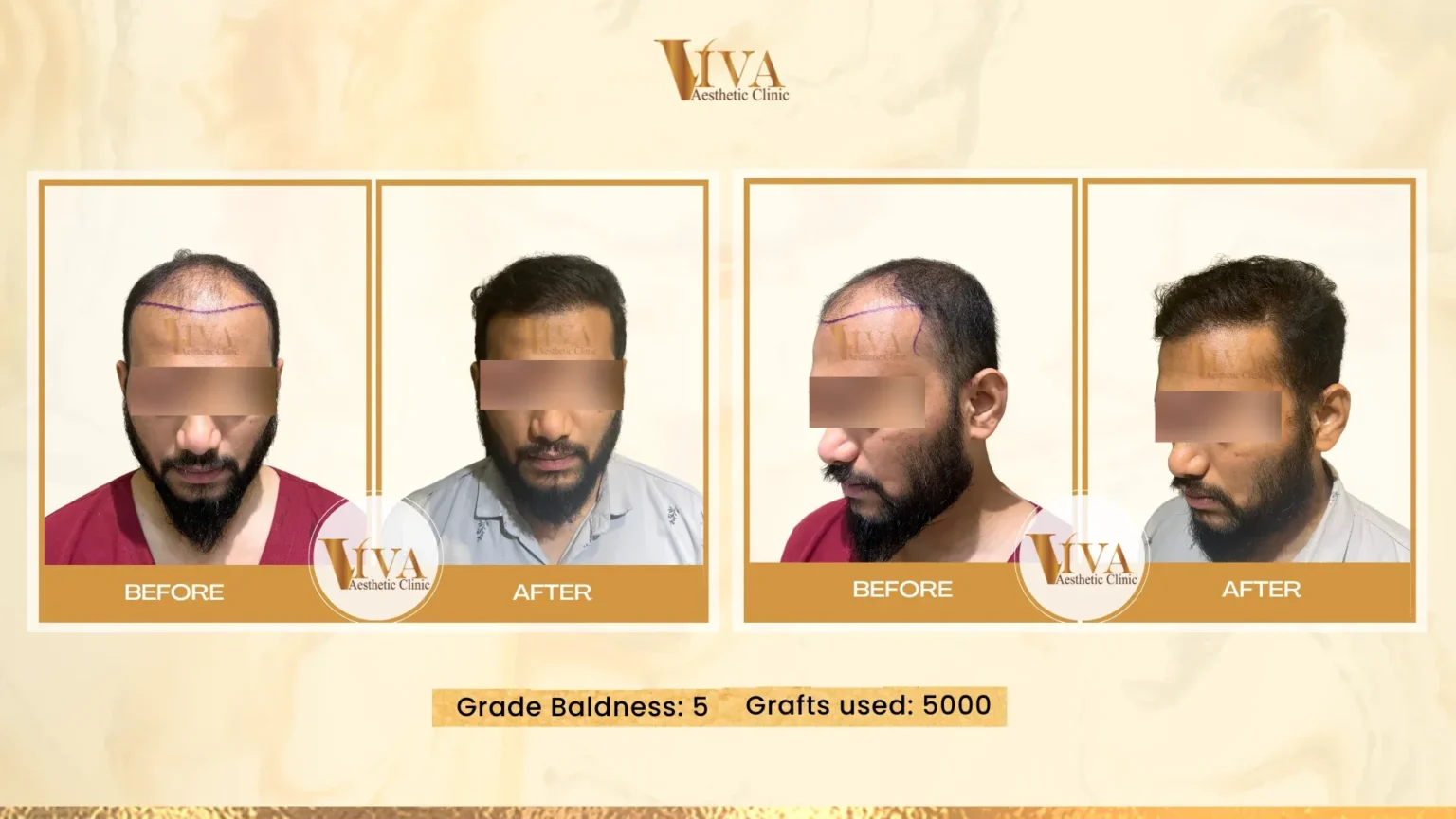Hair Transplant Result