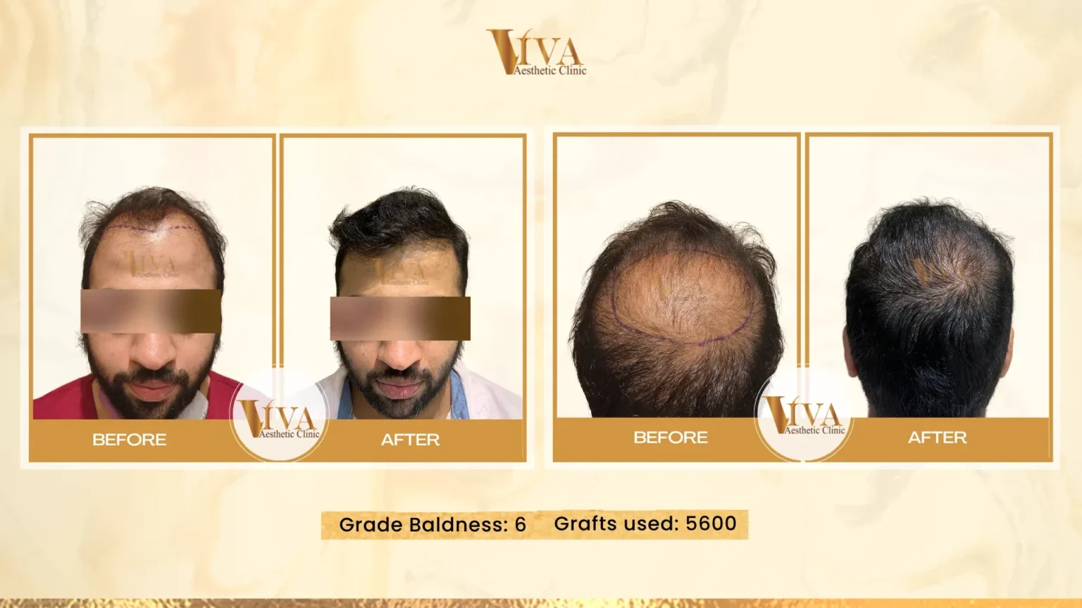 Hair Transplant Result