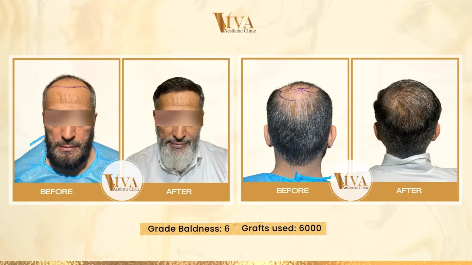 Hair Transplant Result
