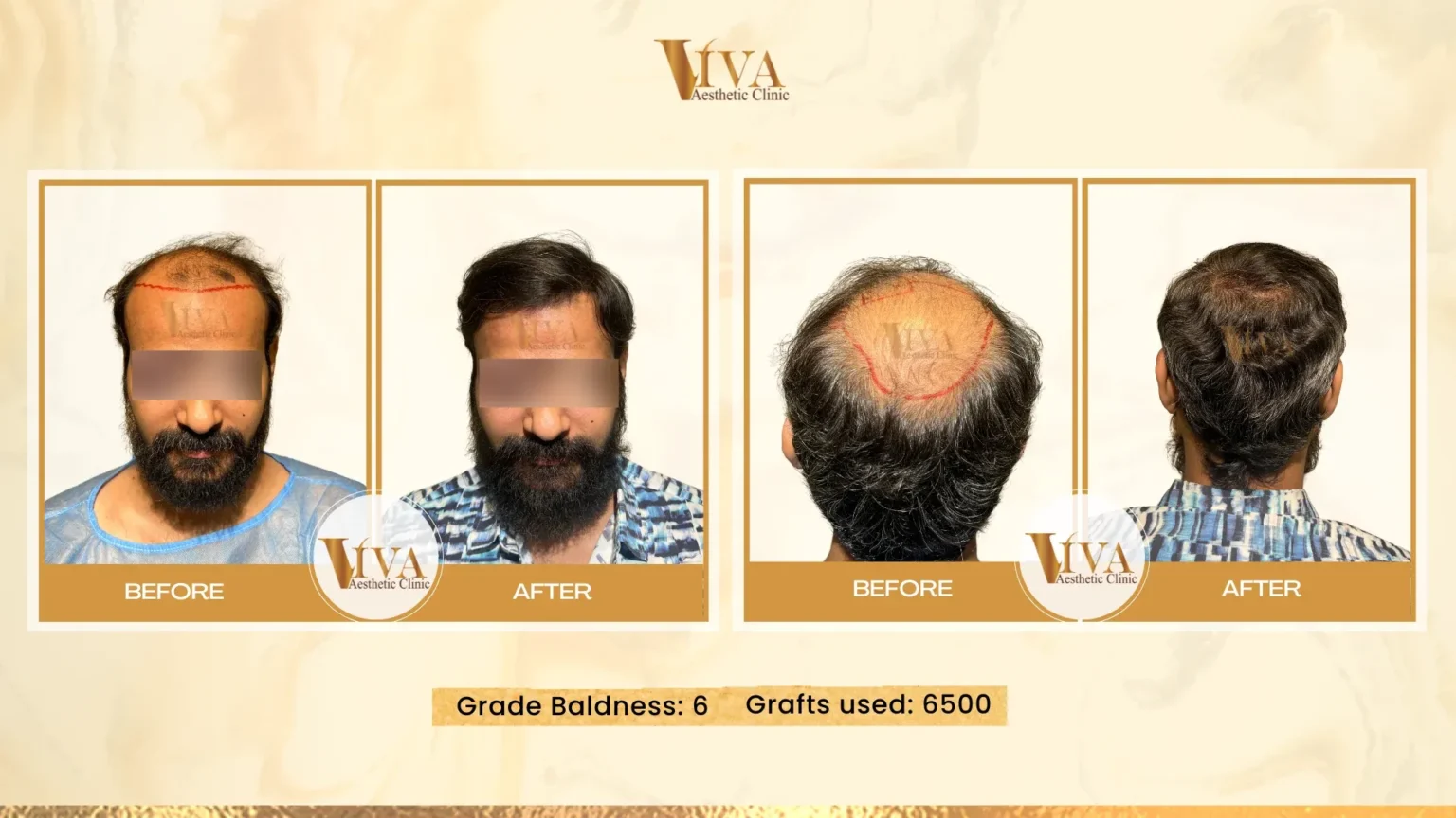 Hair Transplant Result