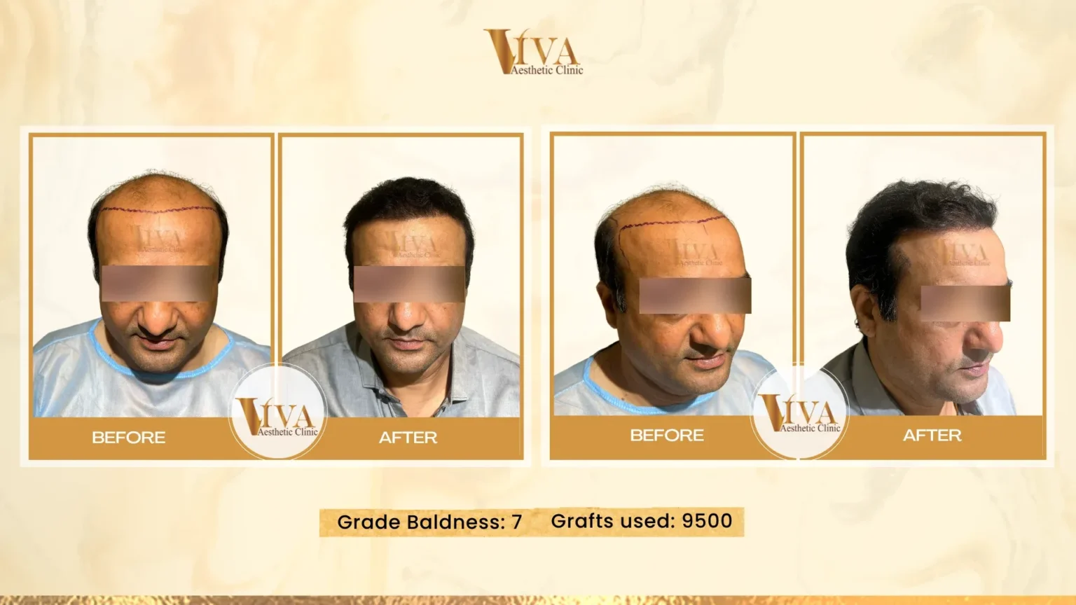 Hair Transplant Result