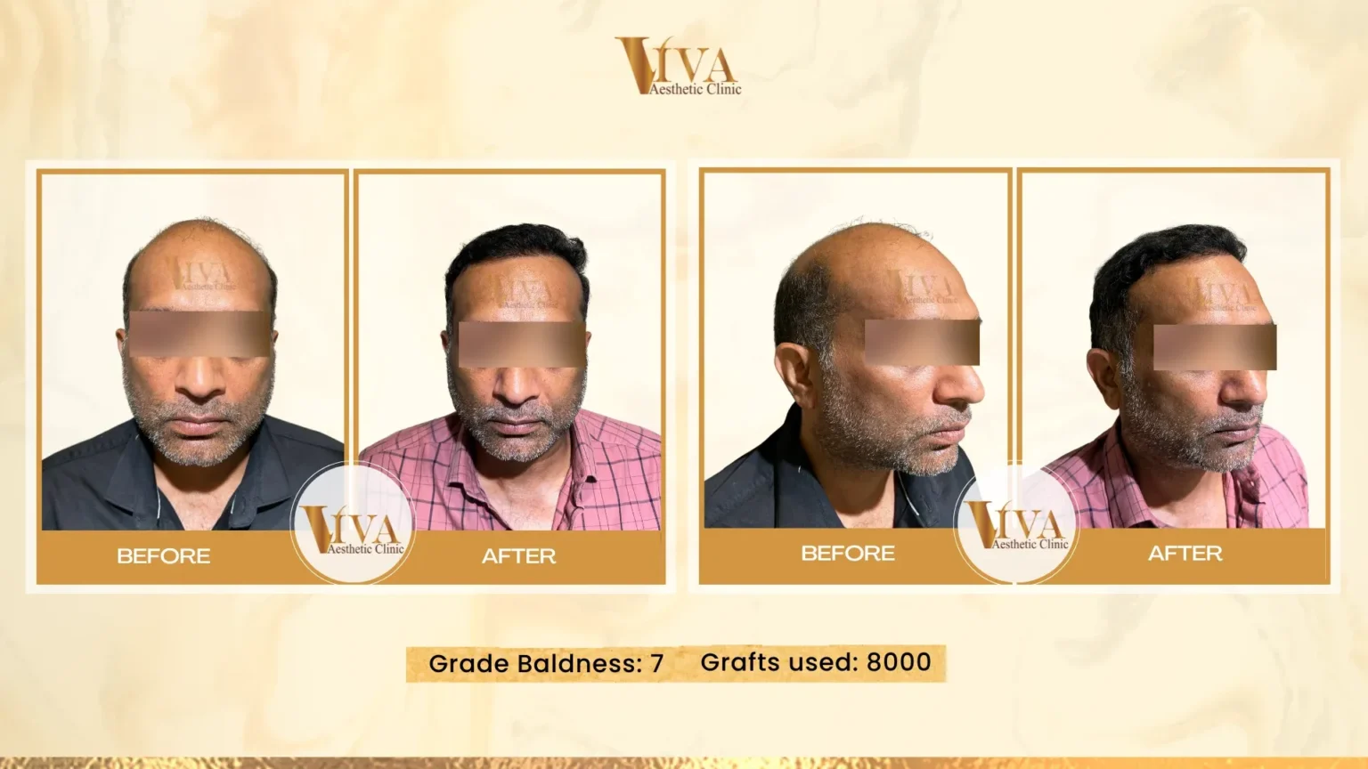 Hair Transplant Result
