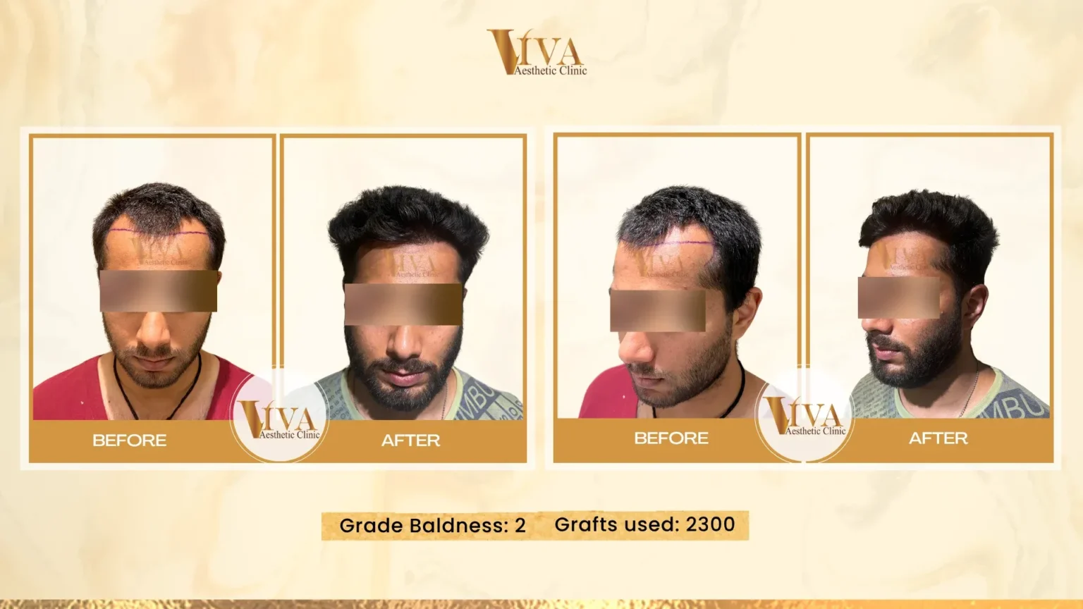 Hair Transplant Result