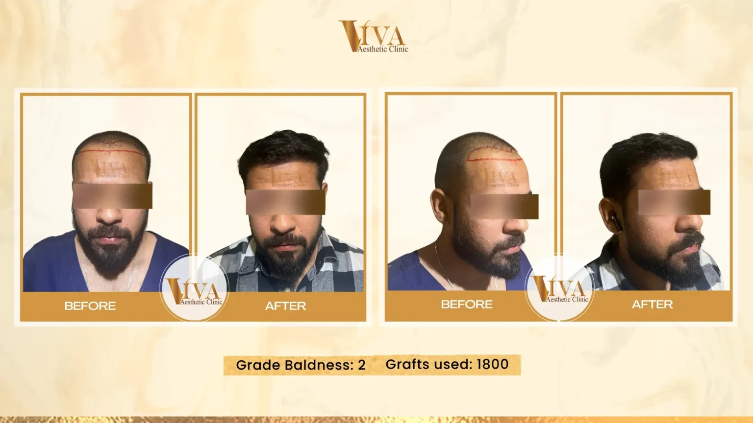 Hair Transplant Result