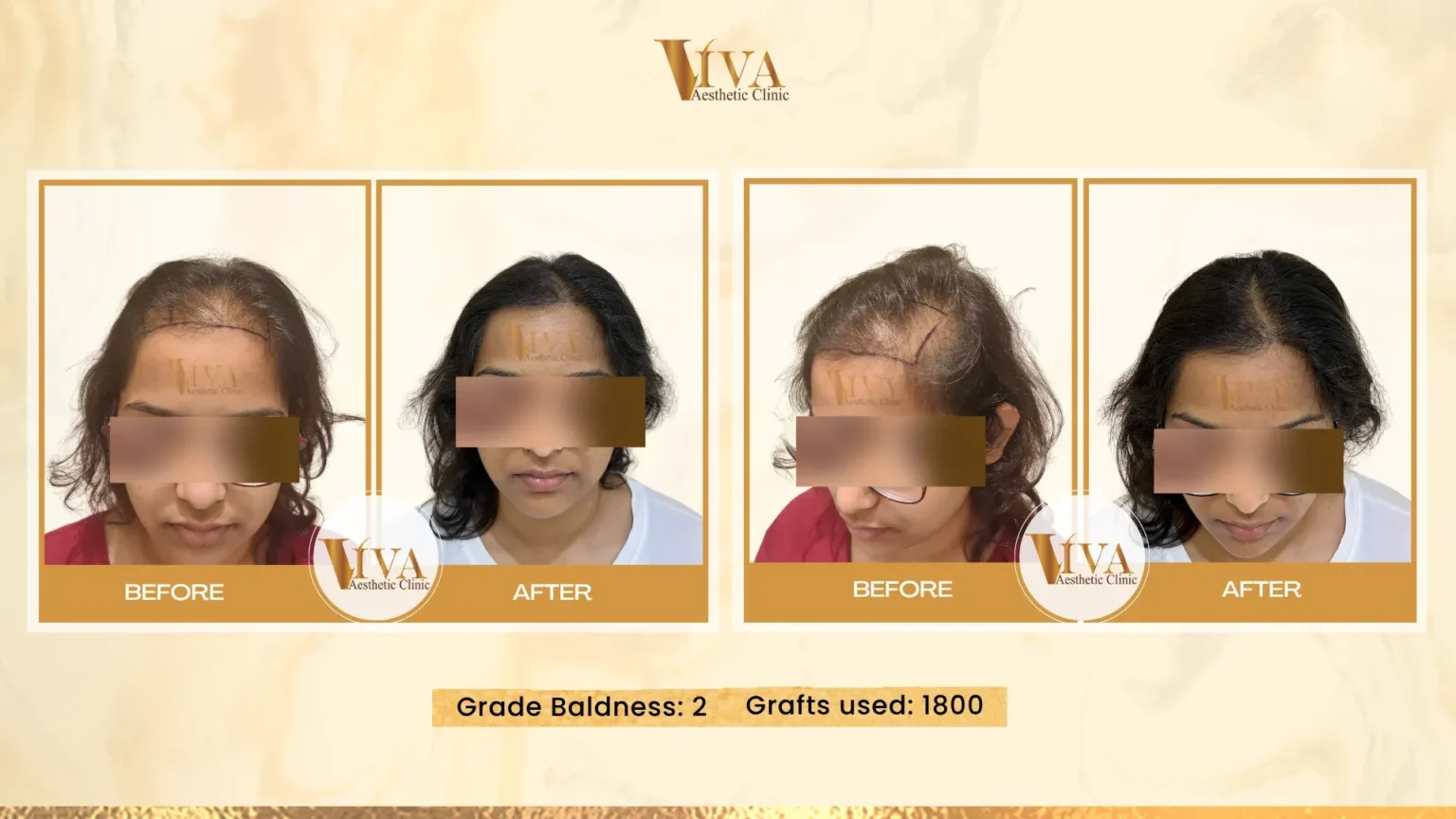 Hair Transplant Result