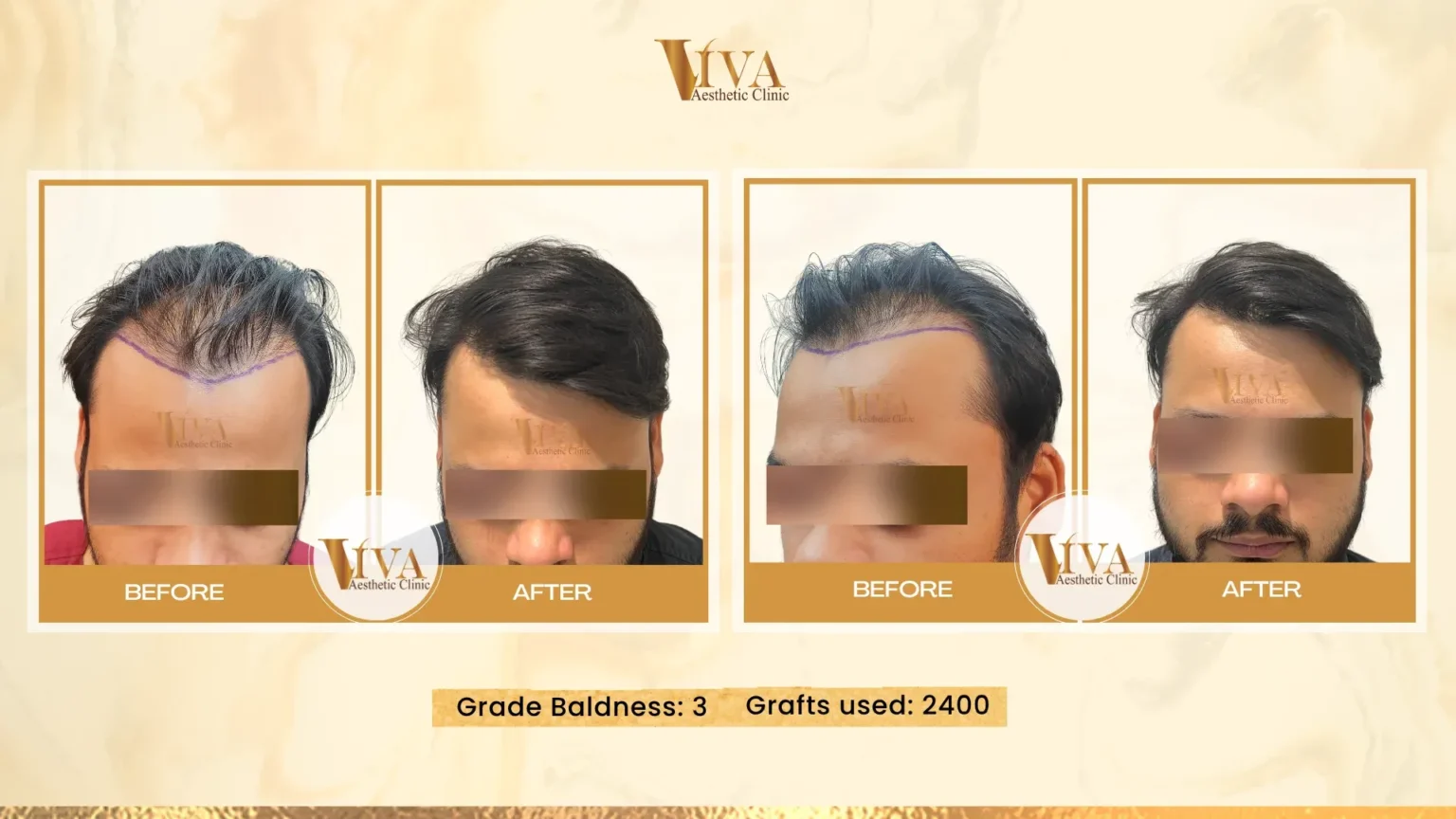 Hair Transplant Result