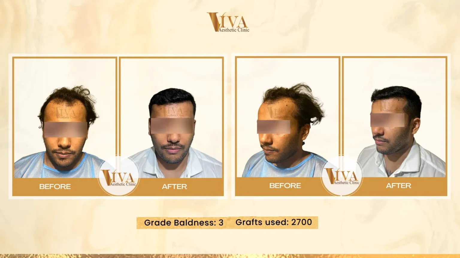 Hair Transplant Result