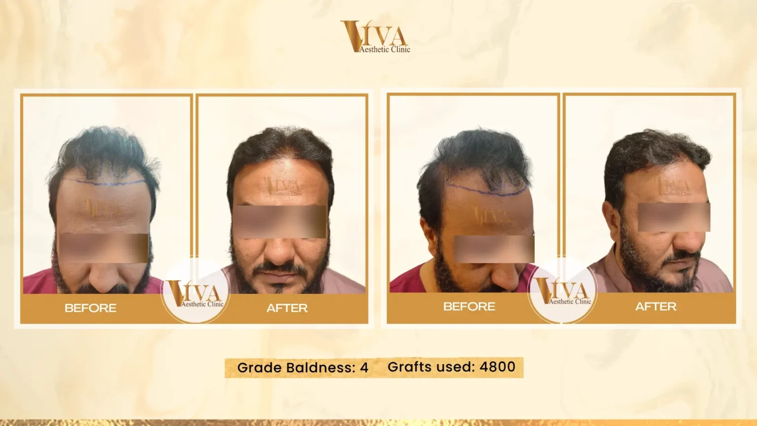 Hair Transplant Result