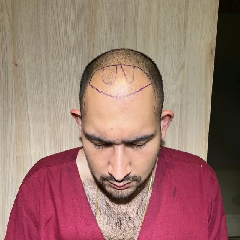 Best Hair Transplant Surgeon in Mumbai