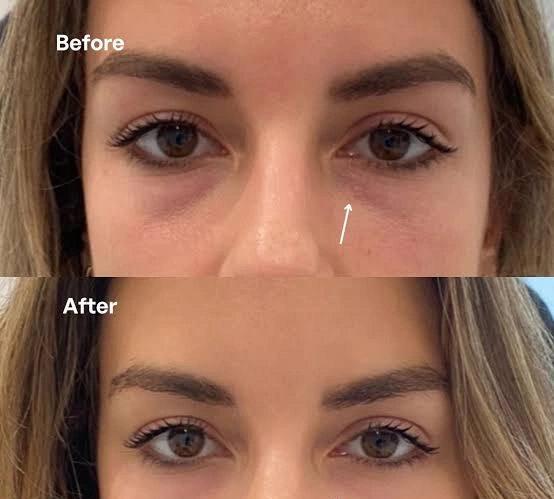 Dermal Fillers for Under Eyes in Mumbai