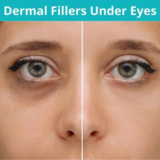 Dermal Fillers for Under Eyes in Mumbai