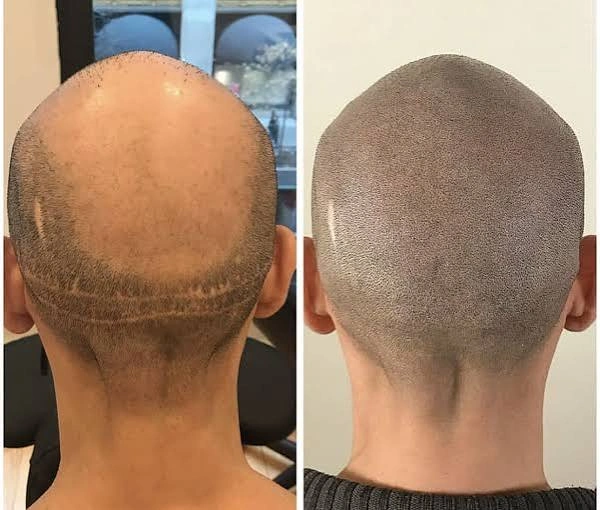 Hair Transplant Scar Treatment in Mumbai