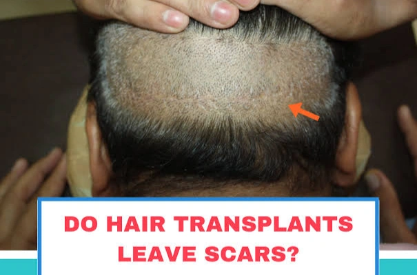 Hair Transplant Scar Treatment in Mumbai
