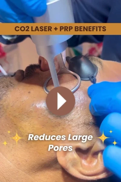 CO2 Laser + PRP Benefits